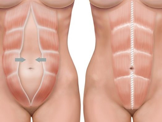 A woman's abdomen undergoes liposuction for body contouring and improved wellness.